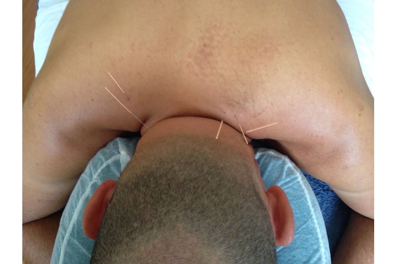 Nathan Burns Acupuncture & Massage - Hawthorn image 1